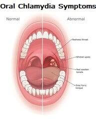 CT STD oral chlamydia symptoms